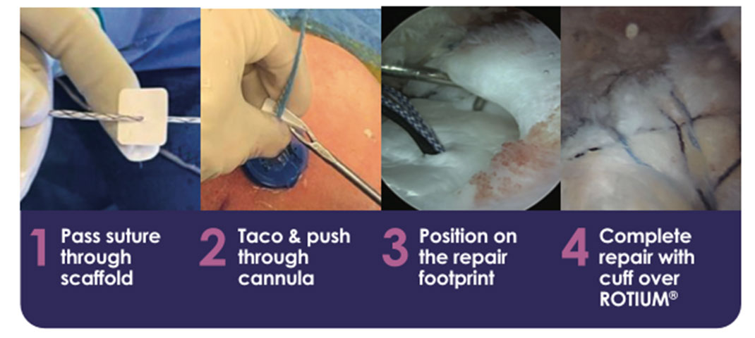 Atreon Orthopedics Rotium Bioresorbable Wick For Rotator Cuff Repair